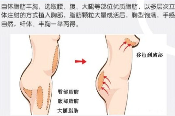 北京孙泽芳脂肪隆胸在线预约通道:线上/电话/网络/现场均可挂号预约孙泽芳脂肪移植医生