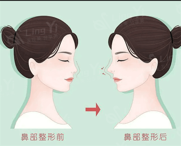 做威宁之星假体隆胸前，有哪些准备和注意事项你必须知道？