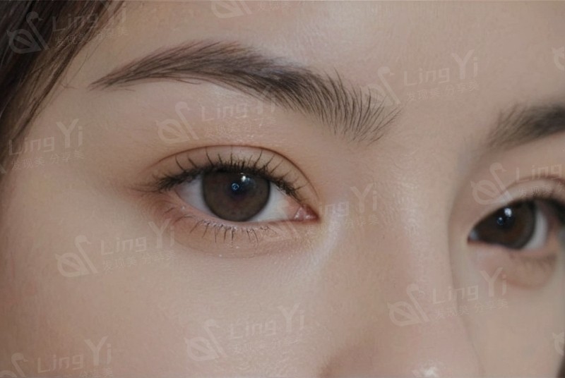 眼纹悄悄爬上眼周咋应对？巧用热玛吉结合护肤手段逆转眼周衰老