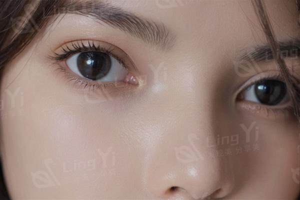 做下颌线提升会留疤吗？超声炮/埋线/手术，哪种适合你？
